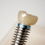 서산임플란트치과 – 상실된 치아를 대체하기 위한 최선의 선택
