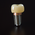 Neo 임플란트 가격 – 저렴한 치과용 임플란트